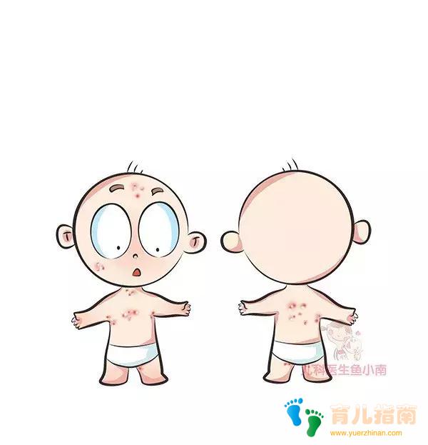 湿疹、热疹、荨麻疹,……各类皮疹都是啥样子?怎么治疗和护理?