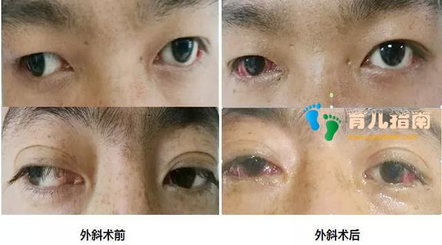 关于儿童斜视，爸妈想知道的都在这里了