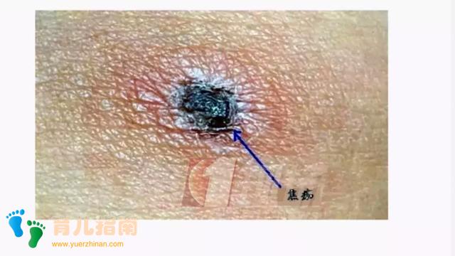 当心!深圳男童被这种小虫咬后高烧10天未退,严重可致命