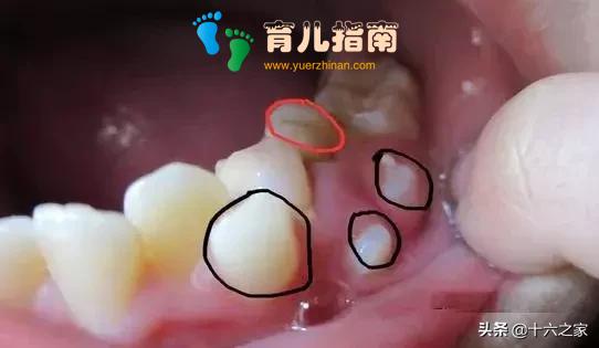 孩子新换的门牙出现锯齿状?长大了会消失吗?