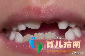 孩子新换的门牙出现锯齿状?长大了会消失吗?