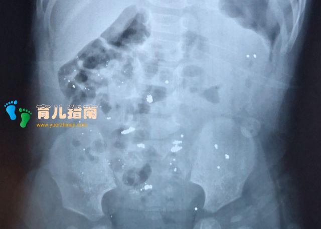 4岁宝宝误食水银”,奶奶给孩子一杯饮品,真的救了”孩子