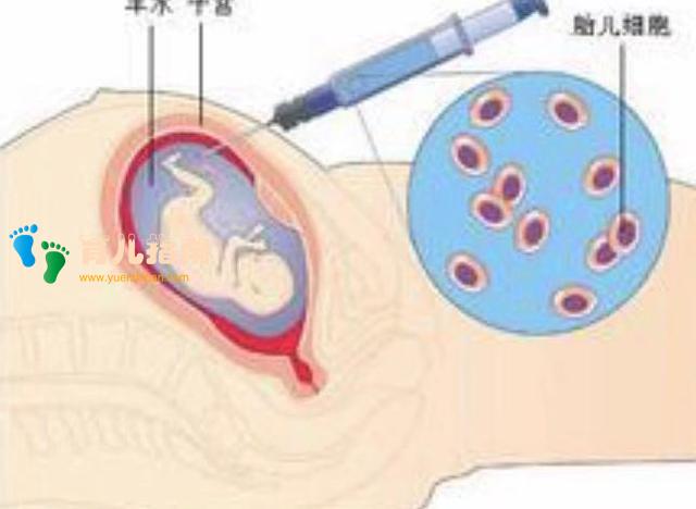 羊水穿刺检测，您了解吗？