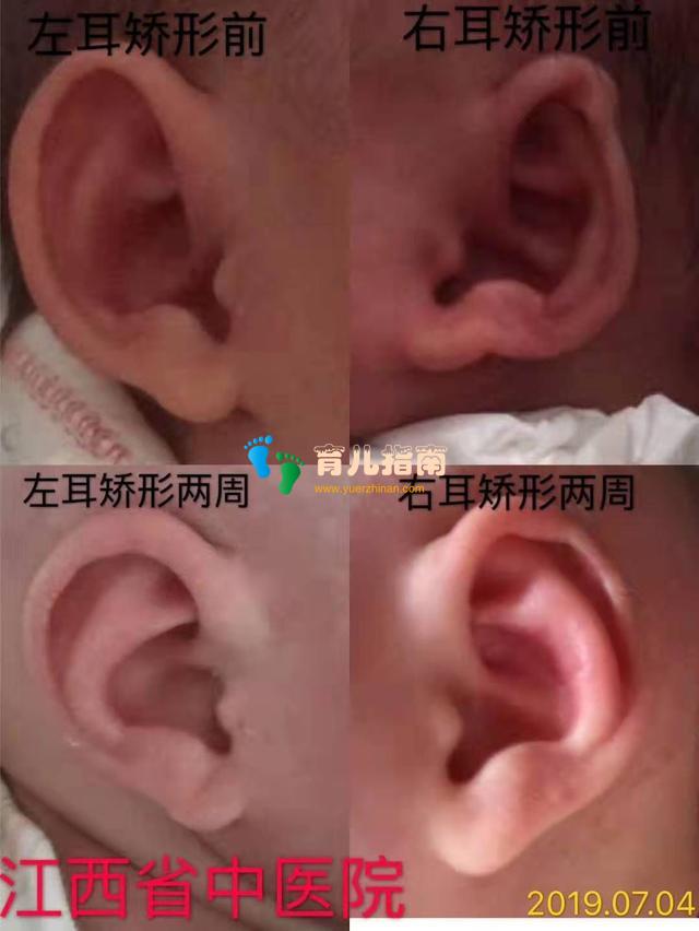 新生儿耳廓畸形矫正，千金难买早知道