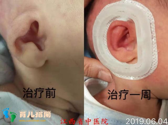 新生儿耳廓畸形矫正，千金难买早知道