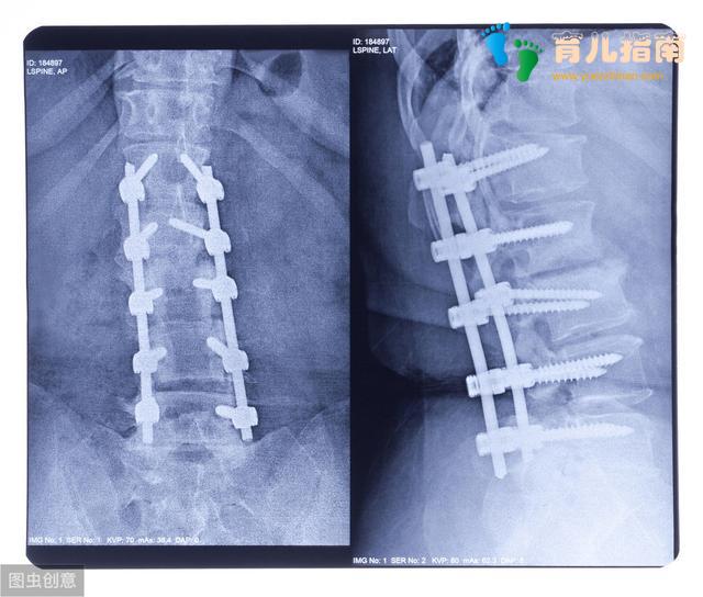 背书包会让孩子脊柱弯曲?关于背书包家长要知道这几点