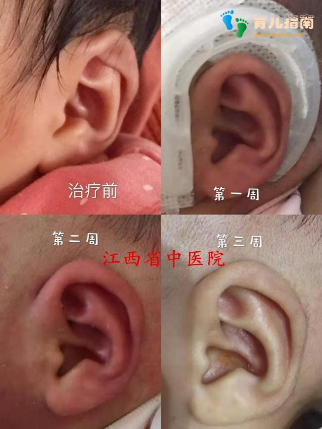 新生儿耳廓畸形矫正，千金难买早知道