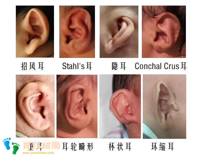 新生儿耳廓畸形矫正，千金难买早知道