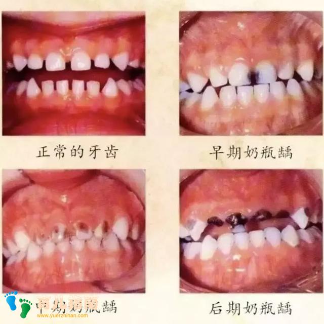 孩子出牙晚是缺钙?最坑娃的10大护牙误区一次说清