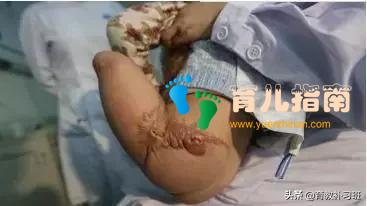 4岁宝宝没了双腿用手走路,手上布满了老茧,坚强的笑容让人心疼