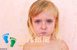幼儿玫瑰疹：羞答答的玫瑰静悄悄的开--冬春时节高发的急性传染病