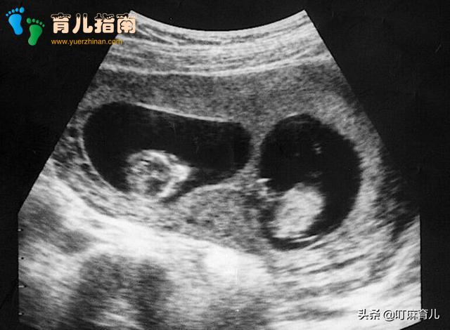 怀双胞胎有什么感觉？跟单胎有什么不同？这些信息孕妇要搞清楚