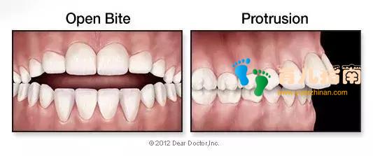 吮吸反射 吮吸反射