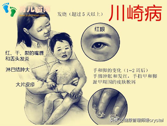 川崎病 川崎病