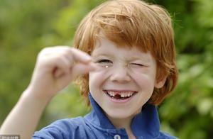 孩子长了两排牙”?乳牙滞留,被忽视的健康隐患 孩子长了两排牙”?乳牙滞留,被忽视的健康隐患