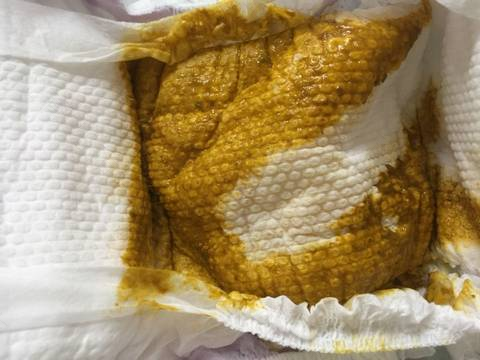 夏季宝宝拉肚子，维生素A和锌来帮忙
