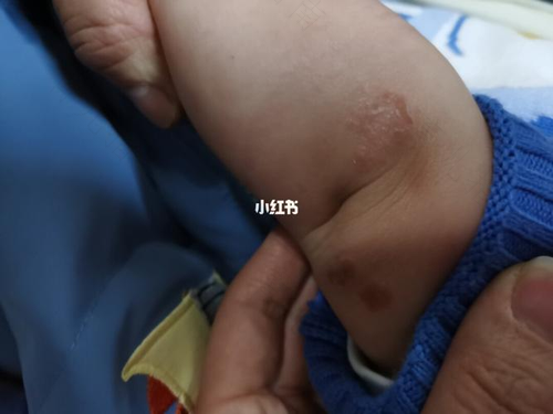 BB为何会被脂溢性湿疹骚扰？