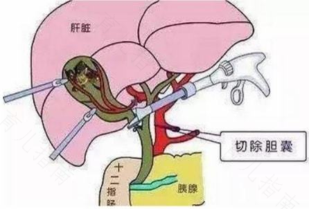 治疗胆石症可以不开刀吗