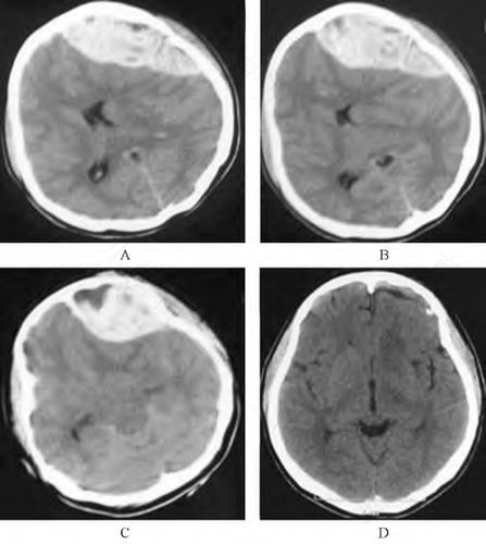 宝宝硬脑膜下血肿有哪些症状