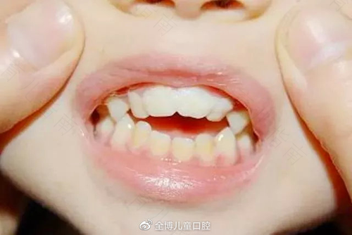 宝贝吮吸手指不健康 宝贝吮吸手指不健康