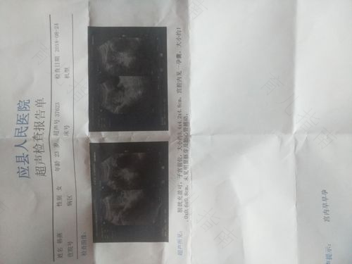 怀孕第39天