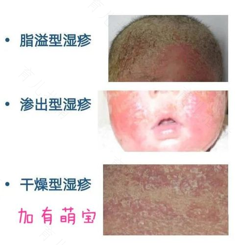 如何照顾好患过敏性湿疹的宝宝