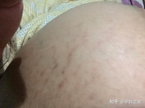 孕期长妊娠纹，主要因为这些因素