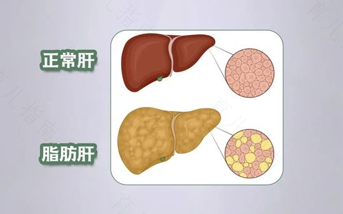 肝功能衰竭的表现及治疗措施