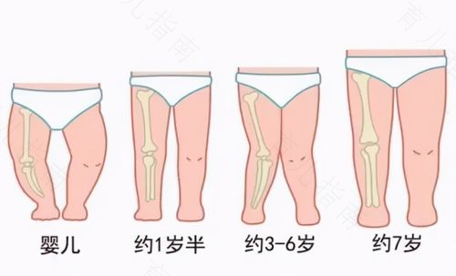 怎样防治儿童X型腿和O型腿 怎样防治儿童X型腿和O型腿