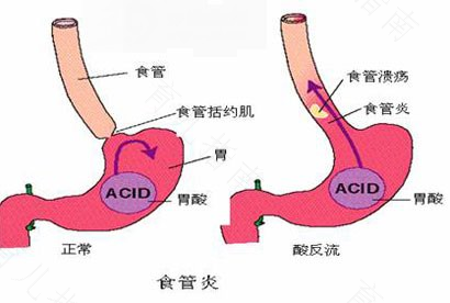 炎症性胃肠病 妈咪如何巧辨别