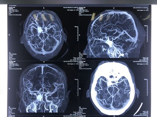 小儿硬脑膜的症状和治疗方法 小儿硬脑膜的症状和治疗方法