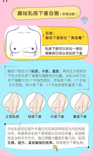 乳房下垂分为几度及其发生原因