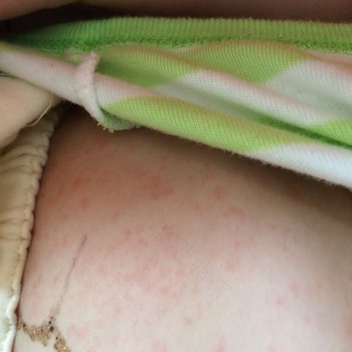 孕期这么做 宝宝以后不不出疹