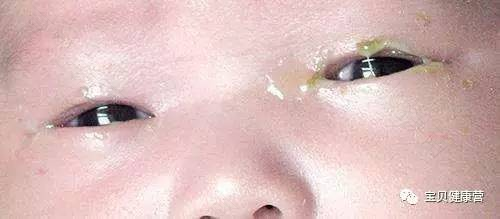 宝宝为什么眼屎多 宝宝为什么眼屎多