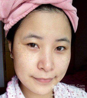 产后妈妈PK黄褐斑大作战 产后妈妈PK黄褐斑大作战