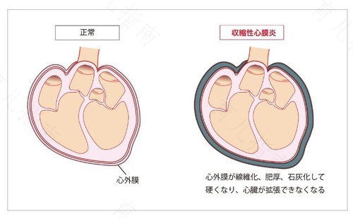 缩窄性心包炎术后如何护理