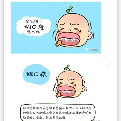 宝宝鹅口疮 药疗食疗双治疗