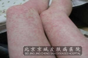 哪些因素会导致真菌引起过敏