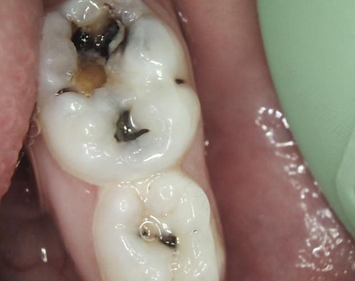 儿童龋齿pk 上海比北京高 儿童龋齿pk 上海比北京高