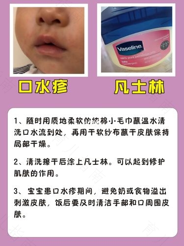 四大皮肤问题 侵扰夏日宝宝 四大皮肤问题 侵扰夏日宝宝