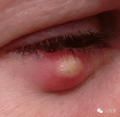 孕妈眼睛发痒 小问题大麻烦