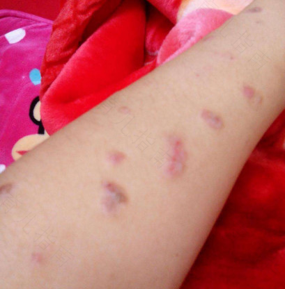 准妈妈们了解妊娠性皮痒症吗 准妈妈们了解妊娠性皮痒症吗