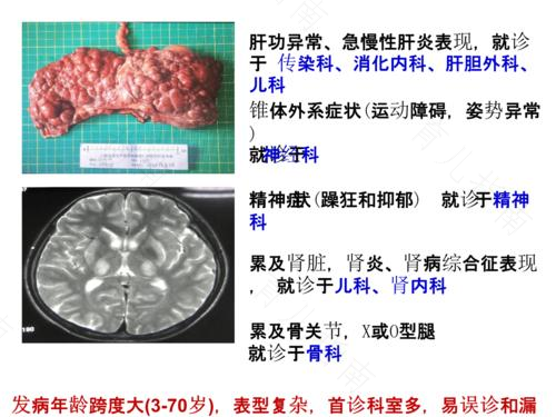 肝豆状核变性需要如何治疗