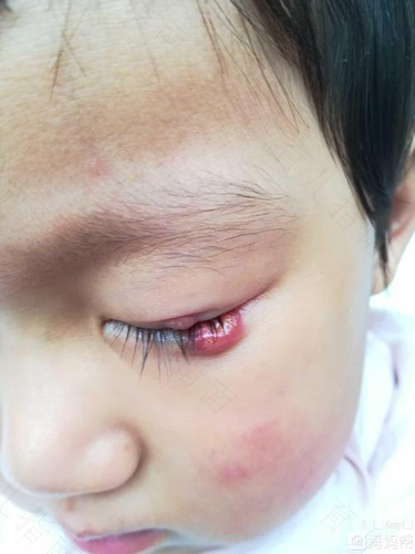 幼儿患上麦粒肿的几种原因