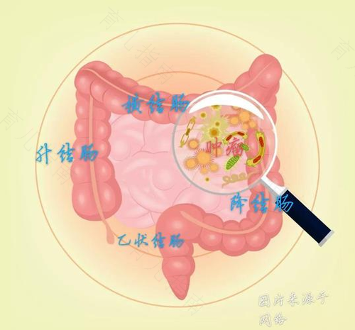 有无结肠癌的易患体质的说法