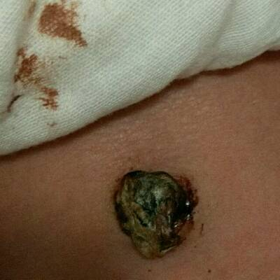 新生宝宝脐带出血怎么办