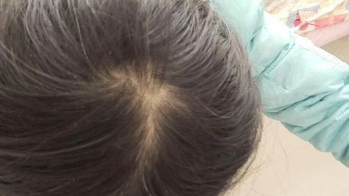 孩子掉头发怎么回事 孩子掉头发怎么回事