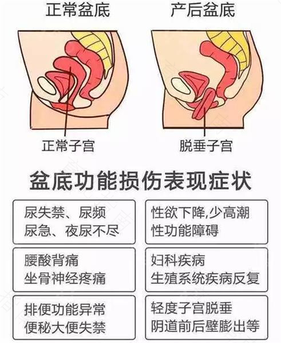 孕期的尿失禁问题如何解决