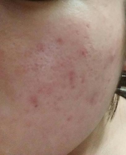 过敏，究竟是怎么回事？