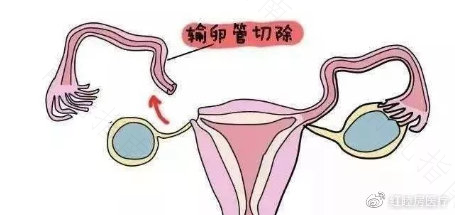 怀孕有卵巢肿瘤还能自然分娩吗 怀孕有卵巢肿瘤还能自然分娩吗